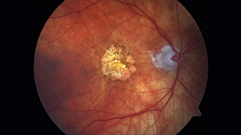 rg_220211_geographic_atrophy_age_related_macular_degeneration_800x450